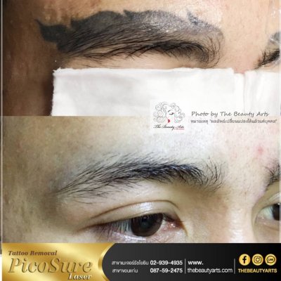 LASER TATTOO REMOVAL
