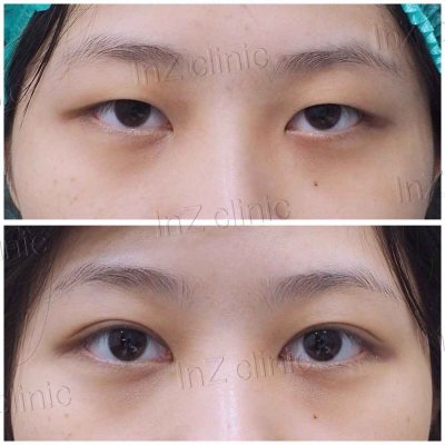 Small-Incision Blepharoplasty