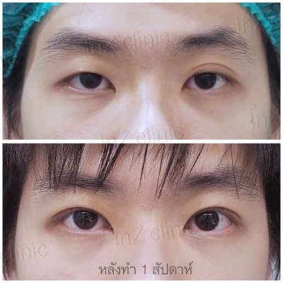 Small-Incision Blepharoplasty