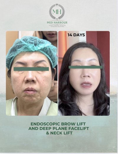 Deep Plane Facelift with Free Necklift