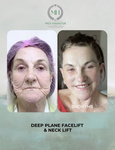 Deep Plane Facelift with Free Necklift