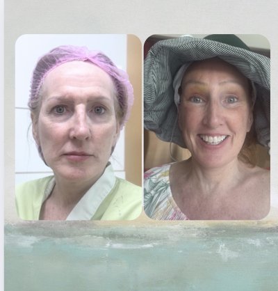 Deep Plane Facelift with Free Necklift