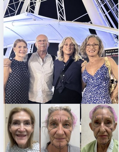 Deep Plane Facelift with Free Necklift