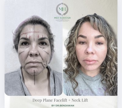Deep Plane Facelift with Free Necklift