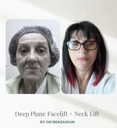 Deep Plane Facelift with Free Necklift