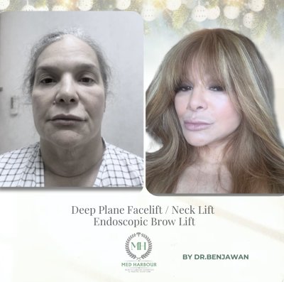 Deep Plane Facelift with Free Necklift