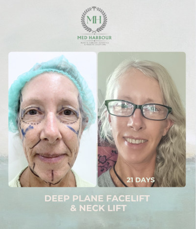 Deep Plane Facelift with Free Necklift
