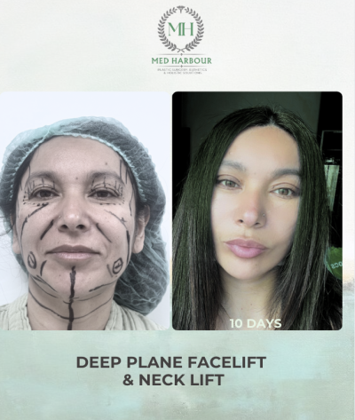 Deep Plane Facelift with Free Necklift