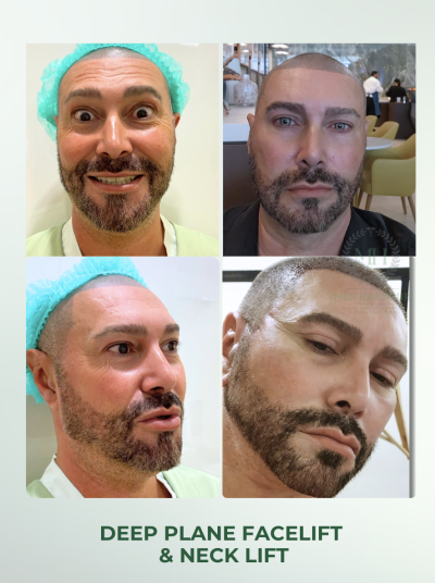 Deep Plane Facelift with Free Necklift