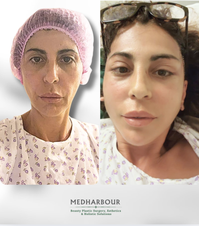 Deep Plane Facelift with Free Necklift