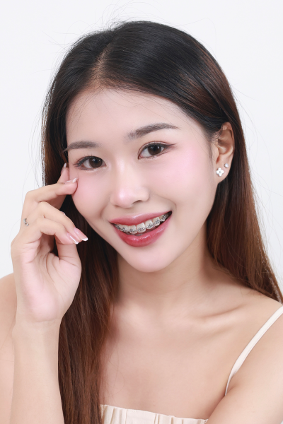 ยกกระชับเอ็นตาล่าง Lateral Canthopexy