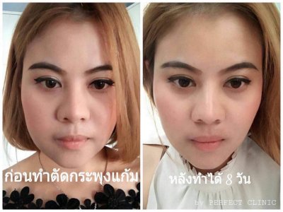 รีวิวRF+ไขมันกระพุ้งแก้ม