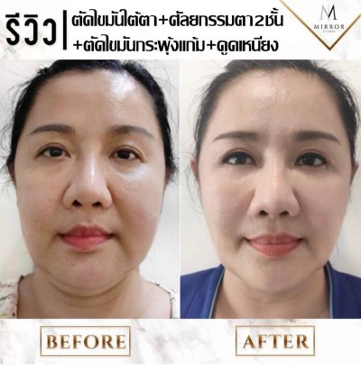 รีวิวRF+ไขมันกระพุ้งแก้ม