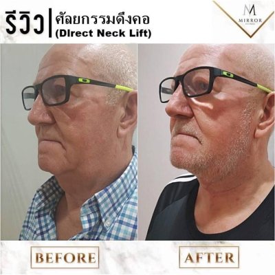 รีวิวดึงหน้าดึงคอ