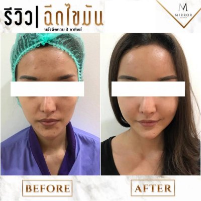 รีวิวฉีดไขมัน