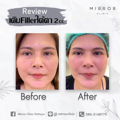 รีวิวฟิลเลอร์