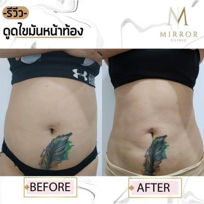 รีวิวดูดไขมัน