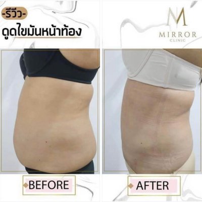รีวิวดูดไขมัน