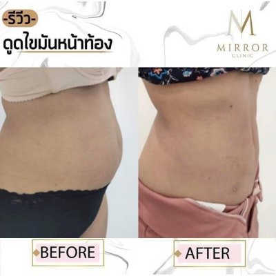 รีวิวดูดไขมัน