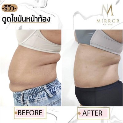 รีวิวดูดไขมัน
