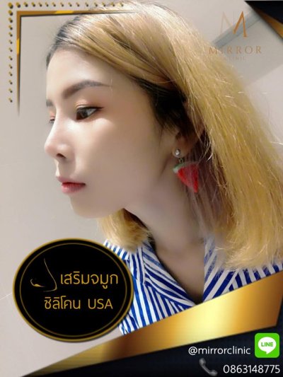 รีวิวเสริมจมูก