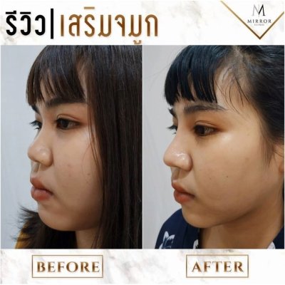 รีวิวเสริมจมูก