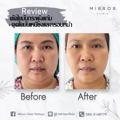 รีวิวดูดเหนียงและไขมันกรอบหน้า