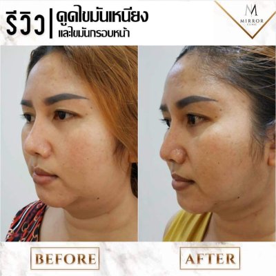 รีวิวดูดเหนียงและไขมันกรอบหน้า