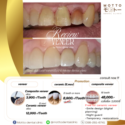 โปรโมชั่นวีเนียร์