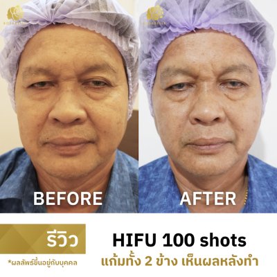 รีวิว HIFU 