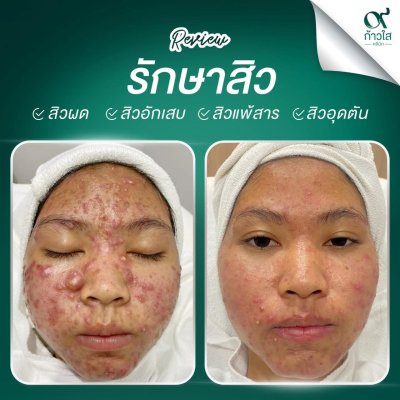 รีวิวรักษาสิว