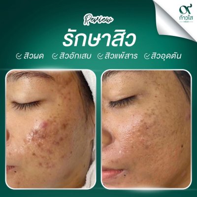 รีวิวรักษาสิว