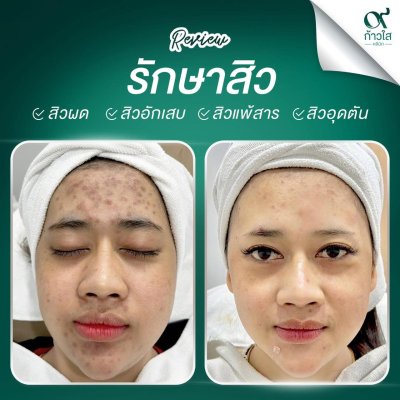 รีวิวรักษาสิว