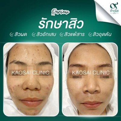 รีวิวรักษาสิว