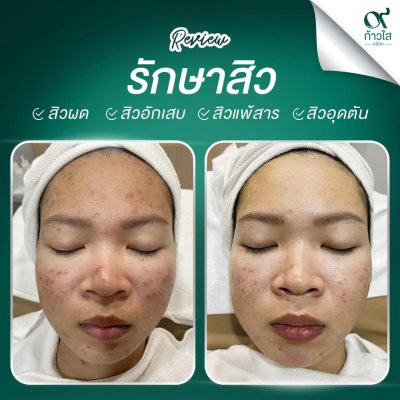 รีวิวรักษาสิว