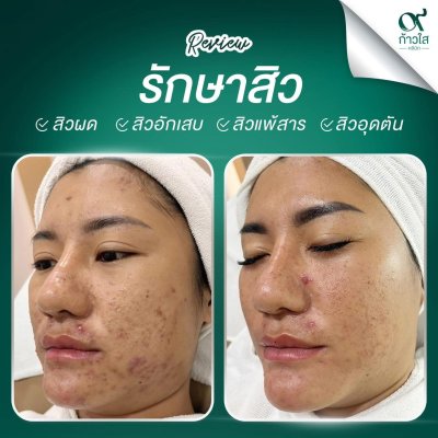 รีวิวรักษาสิว