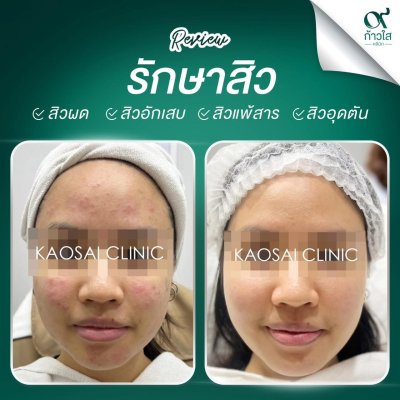 รีวิวรักษาสิว