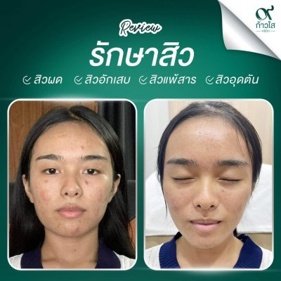 รีวิวรักษาสิว