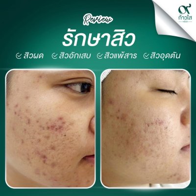 รีวิวรักษาสิว