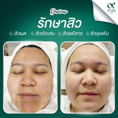 รีวิวรักษาสิว