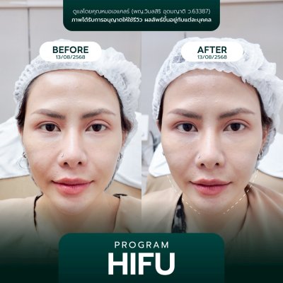 รีวิวยกกระชับ