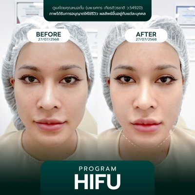 รีวิวยกกระชับ