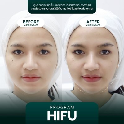 รีวิวยกกระชับ