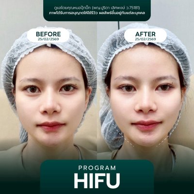 รีวิวยกกระชับ