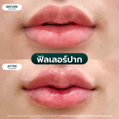 รีวิวฟิลเลอร์ปาก