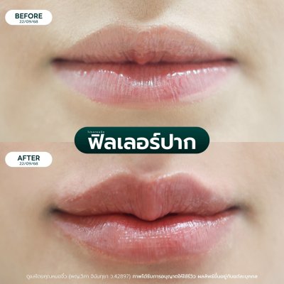 รีวิวฟิลเลอร์ปาก