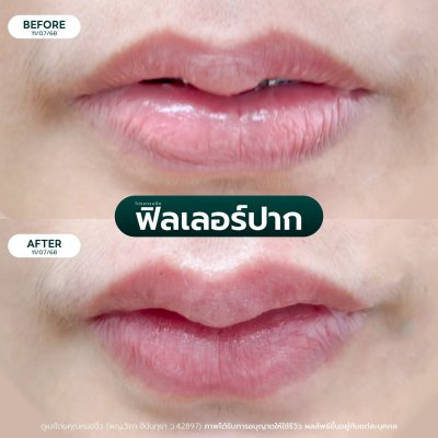 รีวิวฟิลเลอร์ปาก