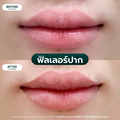 รีวิวฟิลเลอร์ปาก