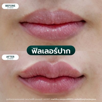 รีวิวฟิลเลอร์ปาก