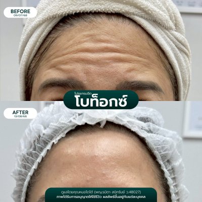 รีวิวโบลดริ้วรอย